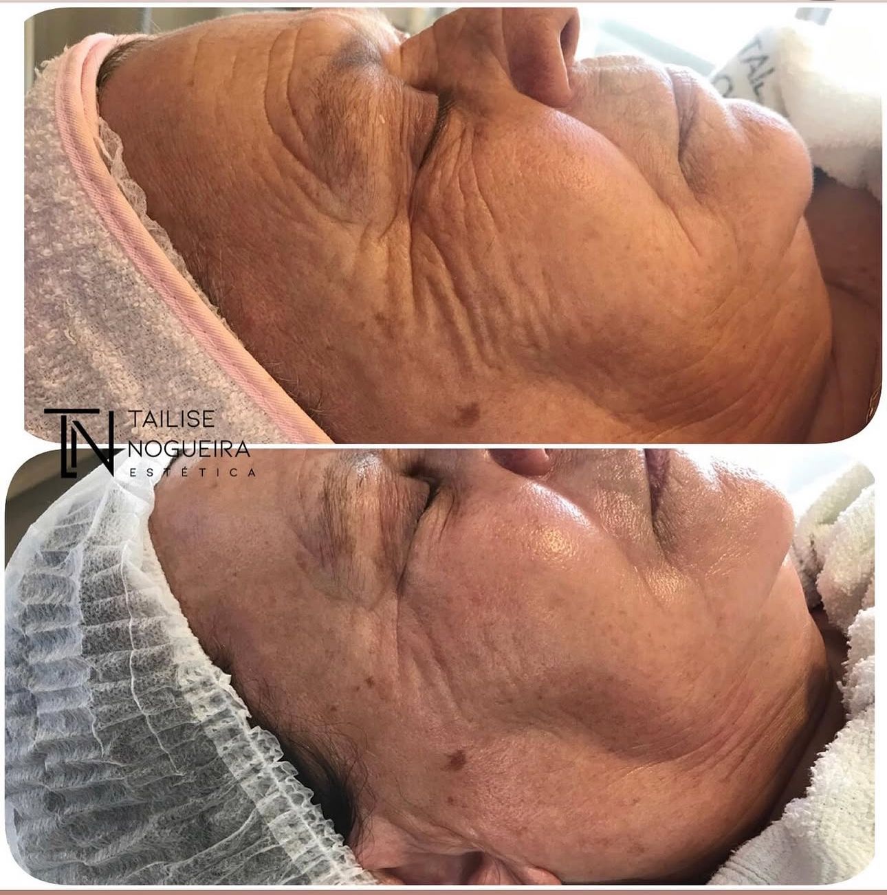 Antes e Depois - Terço Inferior